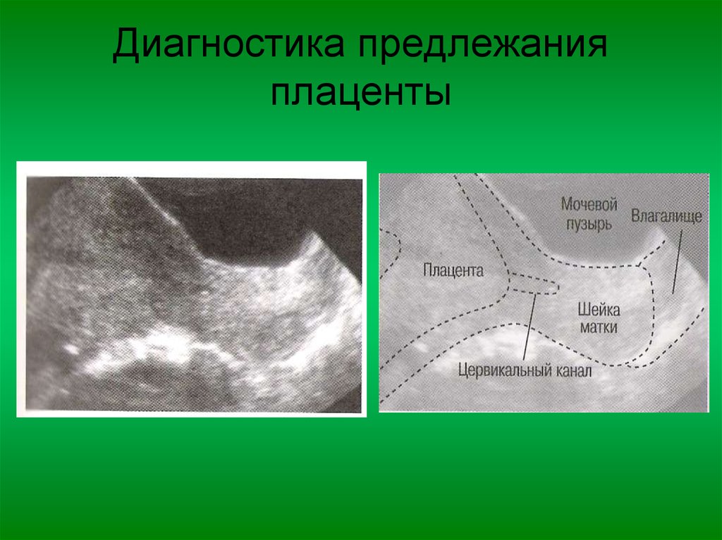 Низкое расположение. Предлежание плаценты УЗИ. Расположение плаценты на УЗИ. Неполное предлежание плаценты на УЗИ. Краевое предлежание плаценты УЗИ.