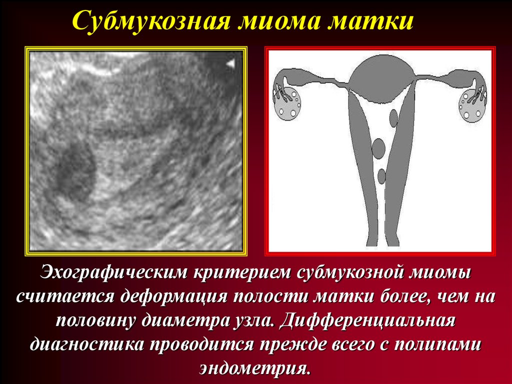 Причины возникновения эндометрии. Субмукозная миома матки. Миома деформирует полость матки. Субмукозно-интрамуральная миома матки.