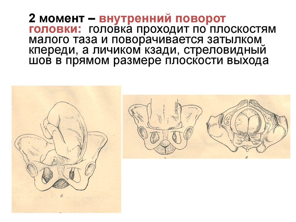 Роды в затылочном предлежании фото