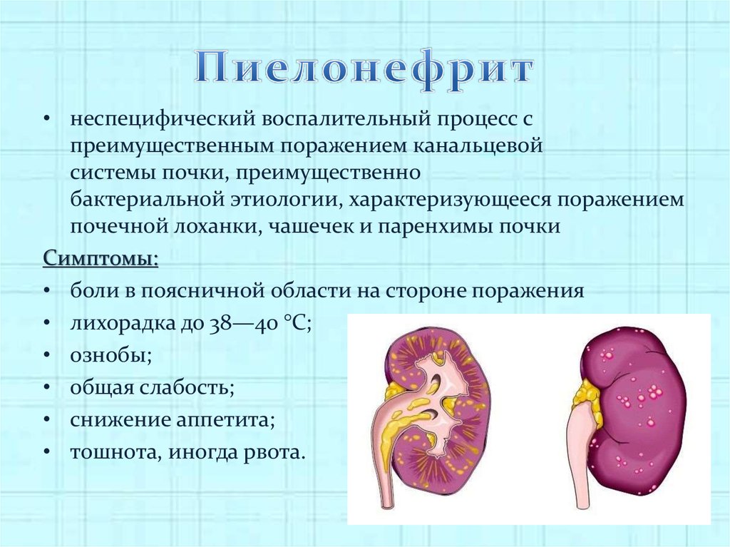 Воспалительные заболевания почек презентация