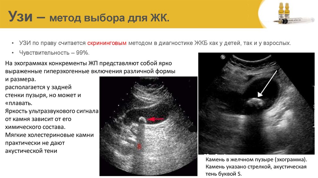 При водянке желчного пузыря в эхографической картине обычно не отмечается