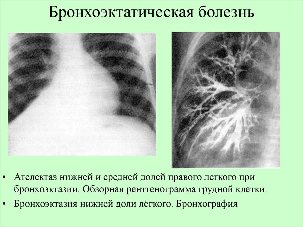 Легочный рисунок усилен в прикорневых зонах