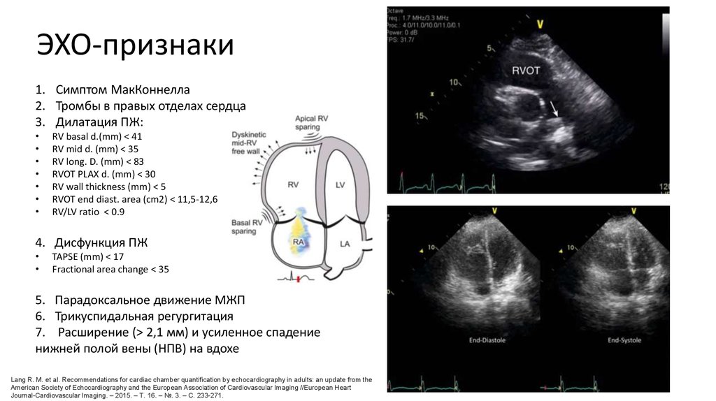 Какой эхо. Признак Макконнелла Эхо это. Признак Макконнелла на эхокардиографии. Признаки Тэла на ЭХОКГ. Эхо признаки Тэла.