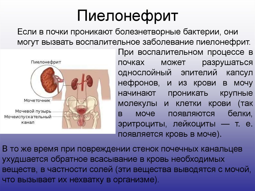 Хронический пиелонефрит боли. Заболевания мочевыделительной системы пиелонефрит. Патология почки. Пиелонефрит. Пиелонефрит причины заболевания.