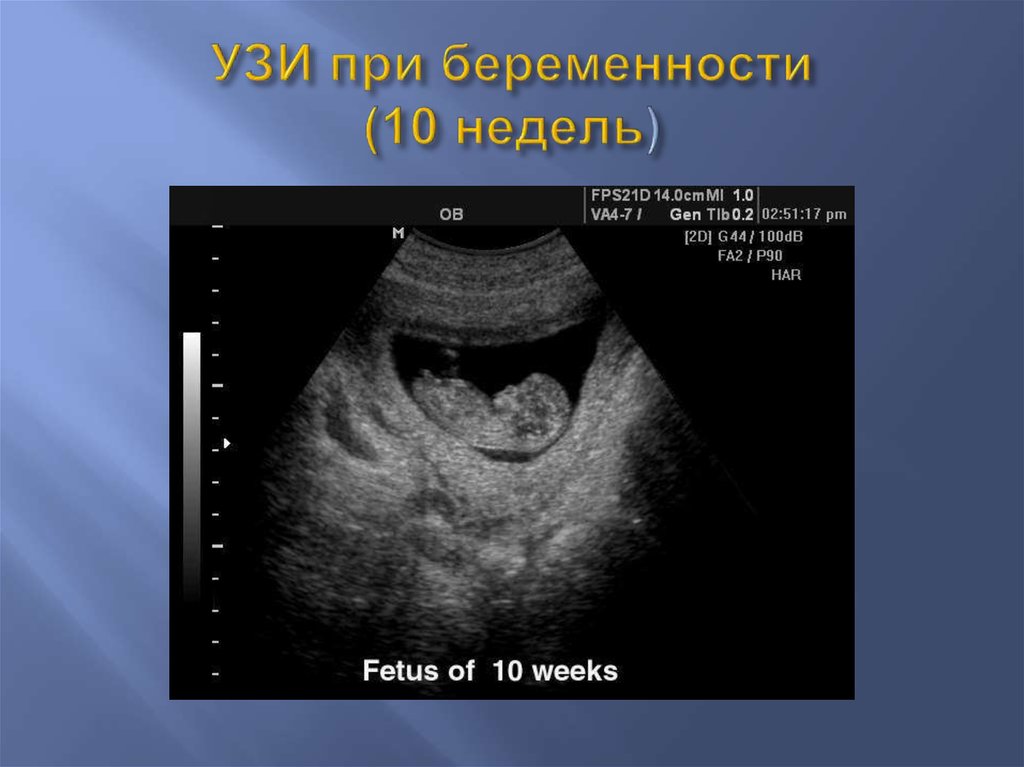 10 недель 3 дня. УЗИ до 10 недель беременности. УЗИ 10 недель беременности. УЗИ беременной 10 недель. УЗИ 9-10 недель беременности.