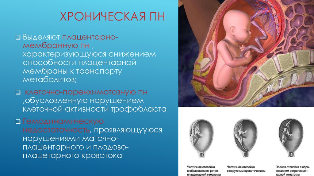 Хроническая плацентарная недостаточность