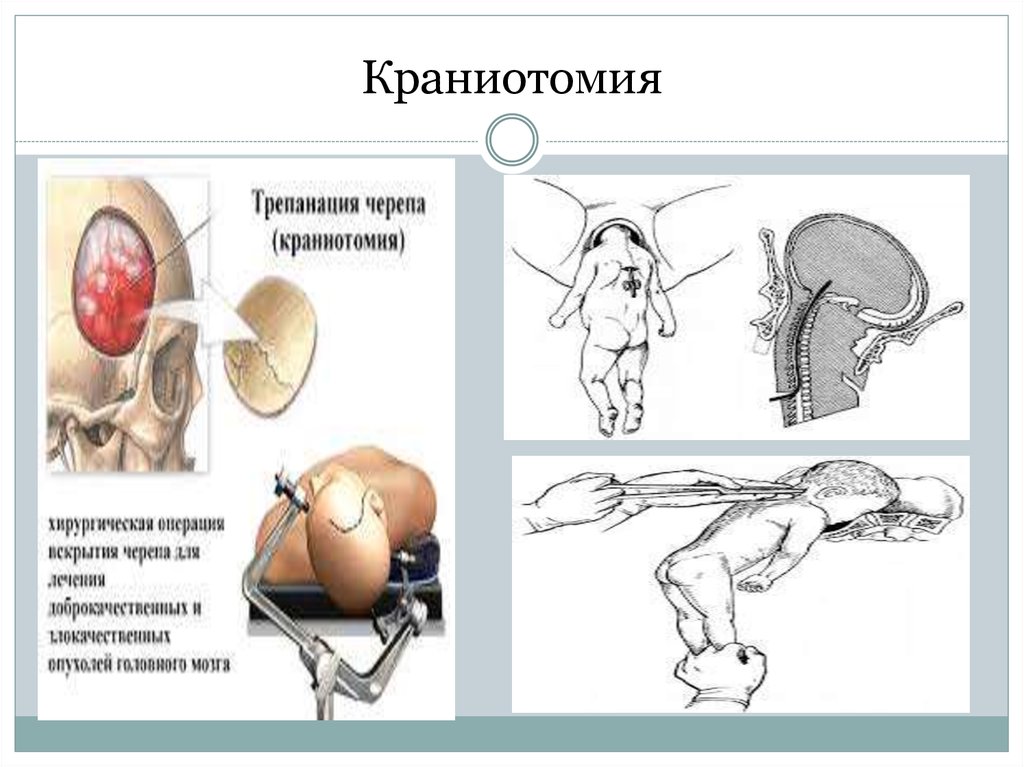 Трепанация черепа презентация