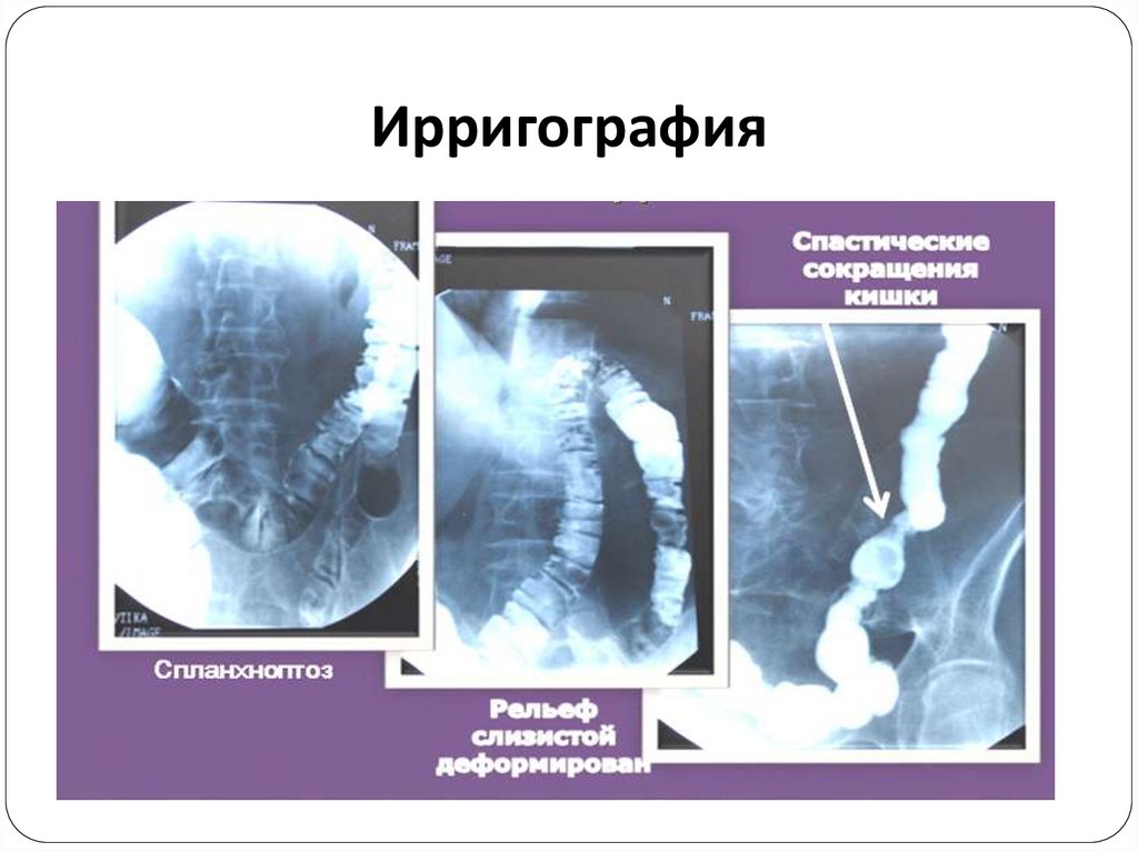 Ирригография. Ирригоскопия иригограмма. Ирригоскопия это рентгенологическое контрастное исследование. Ирригоскопия и ирригография отличия.