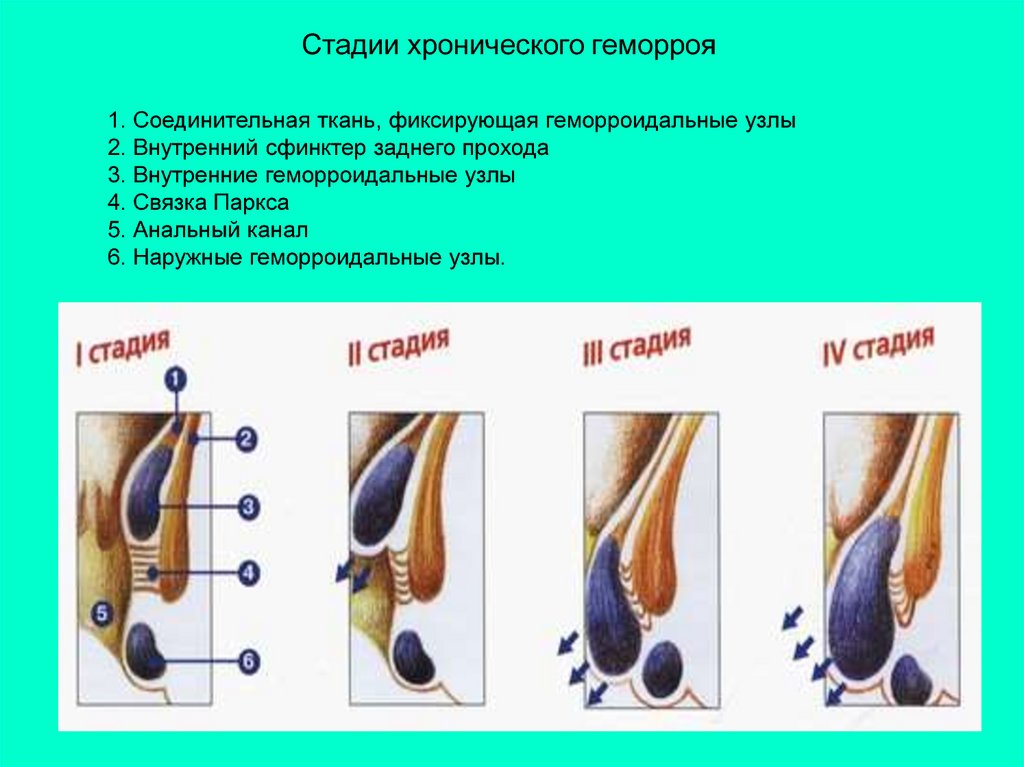 Схема лечения геморроя у мужчин