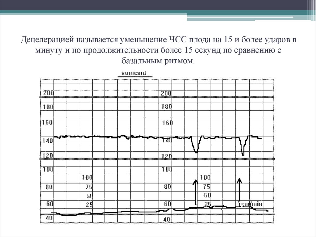Ктг сколько. Децелерации на КТГ. Ранние децелерации на КТГ. Нормальный базальный ритм КТГ. Поздние децелерации на КТГ.