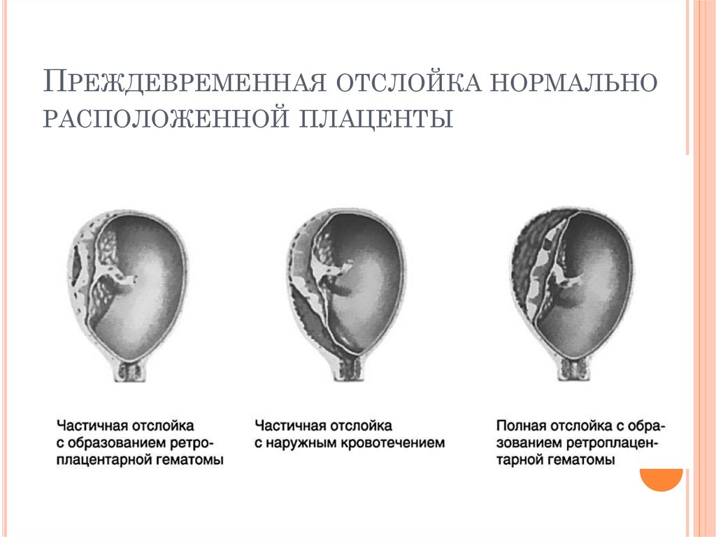 Нормально расположенная плацента. Отслойка нормально расположенной плаценты. Клиническая классификация отслойки плаценты. Преждевременная отслойка плаценты классификация. Клинические проявления отслойки плаценты.