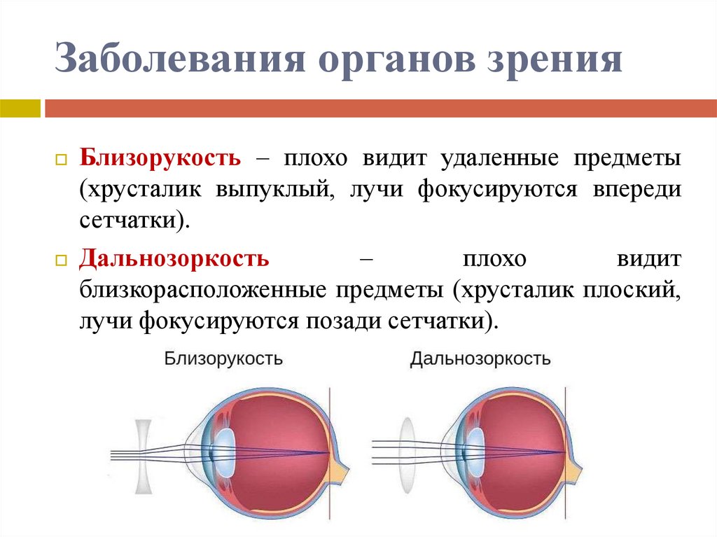 Заболевания органов зрения презентация 8 класс