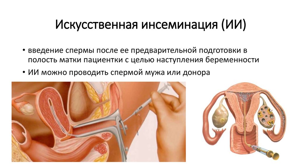 Внутриматочная инсеминация