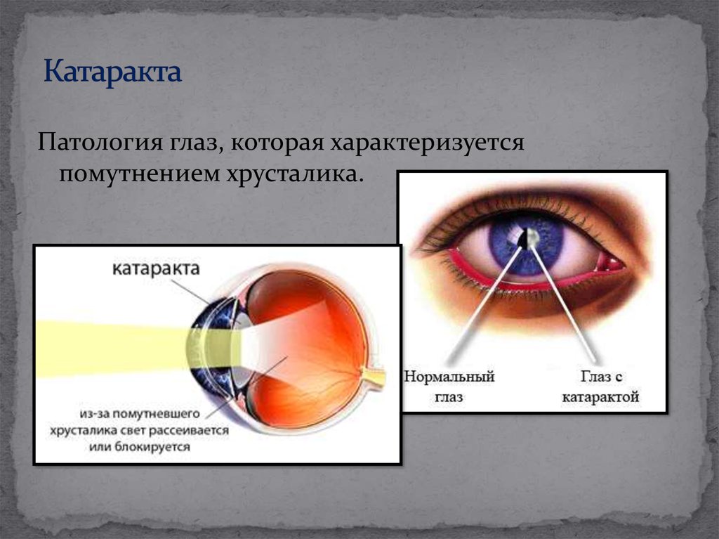 Катаракта глаза. Патологии органов зрения. Хрусталик глаза. Сообщение на тему заболевание глаз катаракта. Катаракта строение глаза.