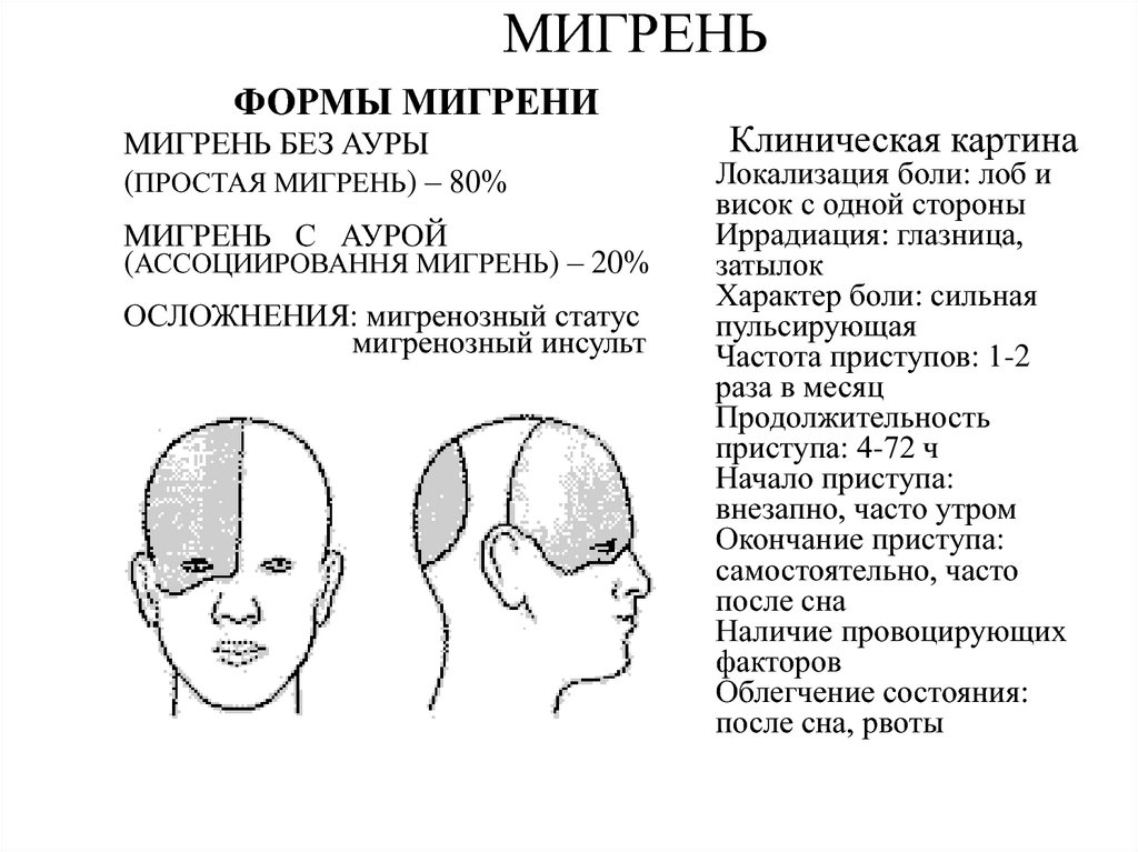 Мигрень у мужчин симптомы и лечение. Схема локализации головной боли. Мигрень локализация. Зоны головы при головной боли.