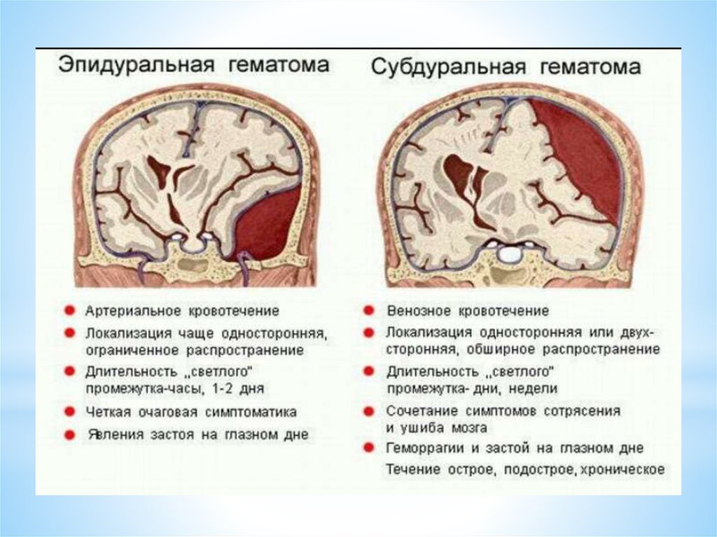 Гематома головного мозга рассасывается. Субдуральное кровоизлияние головного мозга. Субдуральная и эпидуральная гематома. Субдуральная и субарахноидальная гематома. Симптомы субдуральной гематомы.