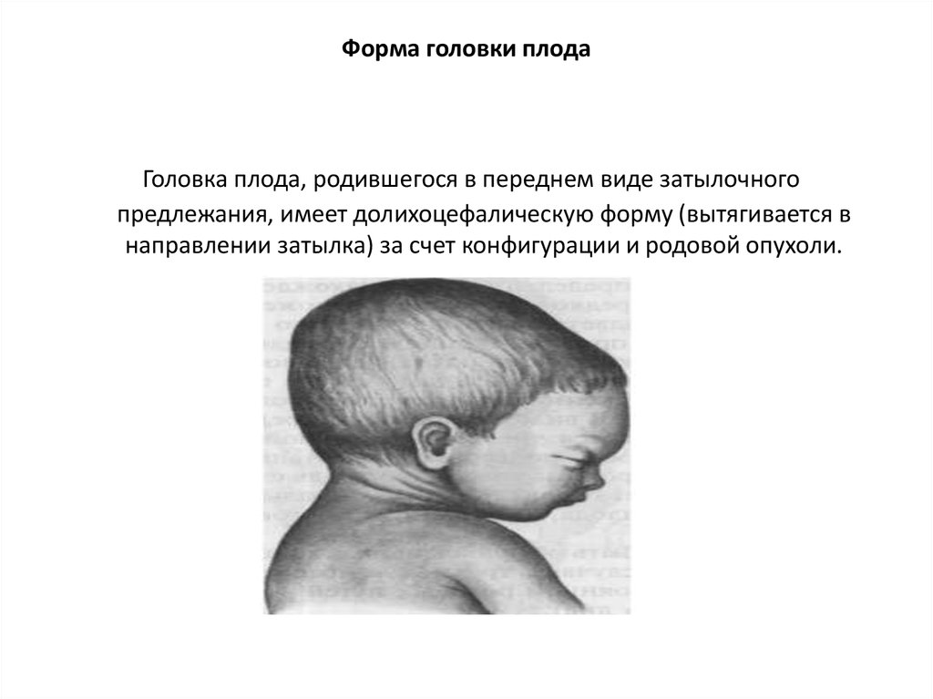 Затылок норма. Форма головы ребенка в тазовом предлежании. Дрлицефатическая форма головы плода. Неправильная форма головы у новорожденного при тазовом предлежании. Форма головки при тазовых предлежаниях.