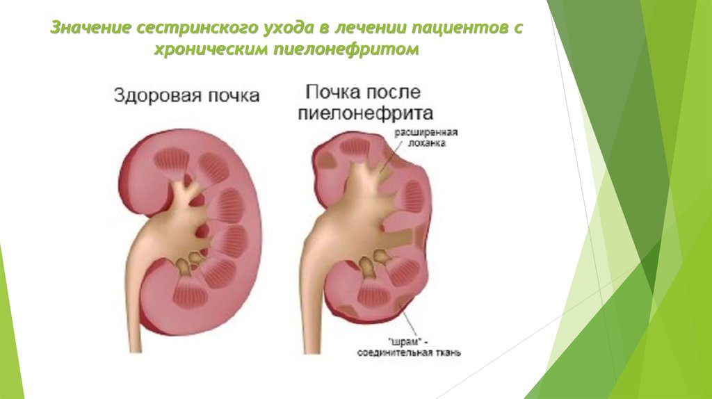 Карта острый пиелонефрит