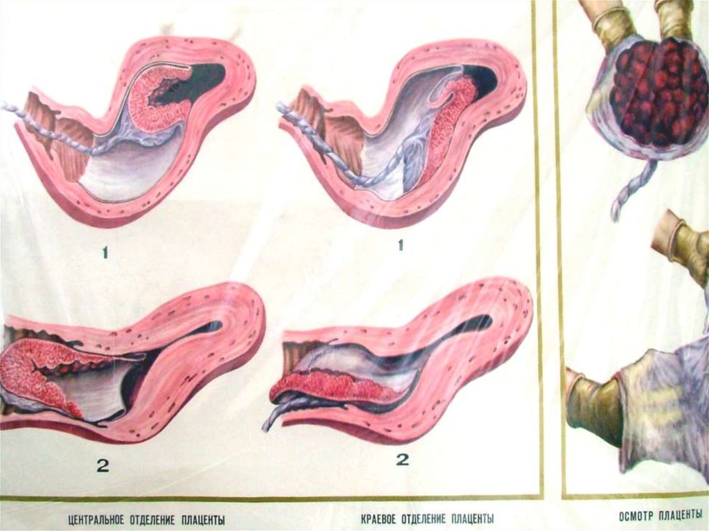 Плацента акушерство презентация