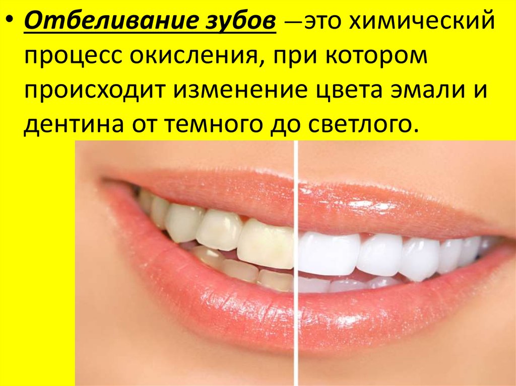 Отбеливание зубов год. Отбеливание зубов презентация. Химическое отбеливание зубов. Внутреннее отбеливание зубов. Химическое отбеливание зубов процедура.