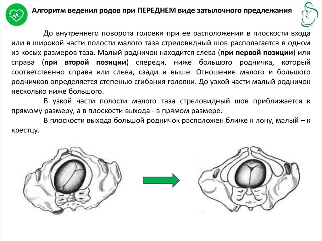 Виды затылочного предлежания. Стреловидный шов в правом косом размере малый Родничок. Стреловидный шов в правом косом размере. Стрелоаидный шов вправом косом размере. Стреловидный шов в Малом косом.