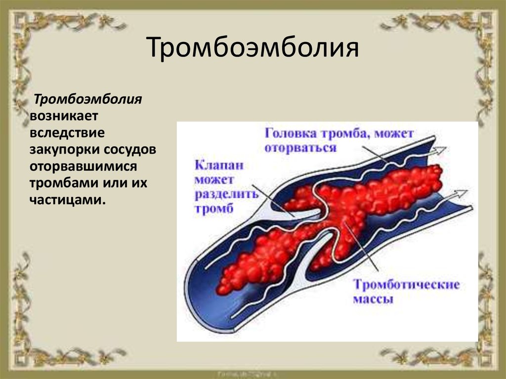 Эмболия тромбы. Тромбоэмболические нарушения.