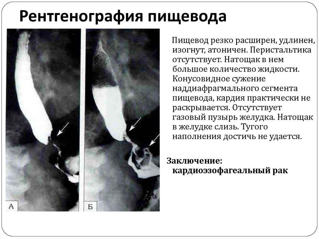 Рентгеноскопия пищевода и желудка в положении тренделенбурга что это такое фото