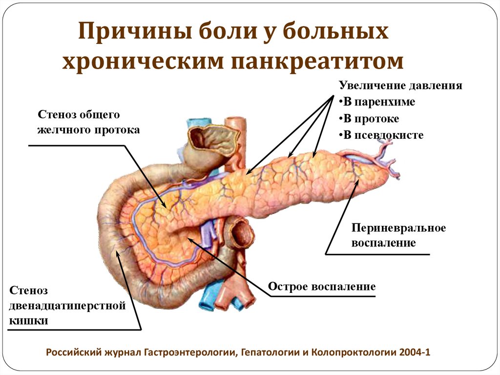 T017904 в схеме лечения хронического панкреатита отсутствуют