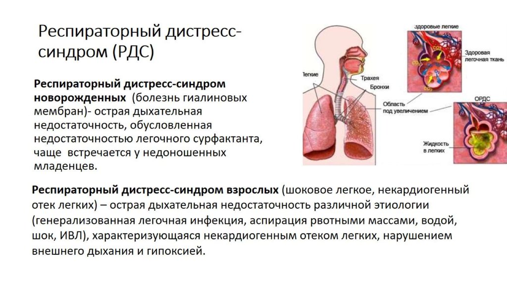 Дистресс легких