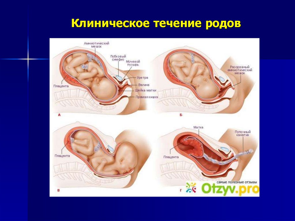 Течении род. Клиническое течение родов. Клиническое течение трех периодов родов. Клиническое течение 2 периода родов. Клиническое течение первого периода родов.