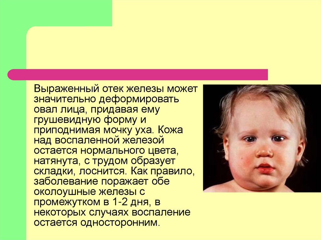 Цитомегалии и эпидемического паротита. Свинка эпидемический паротит. Паротит Свинка презентация. Эпидемический паротит презентация.