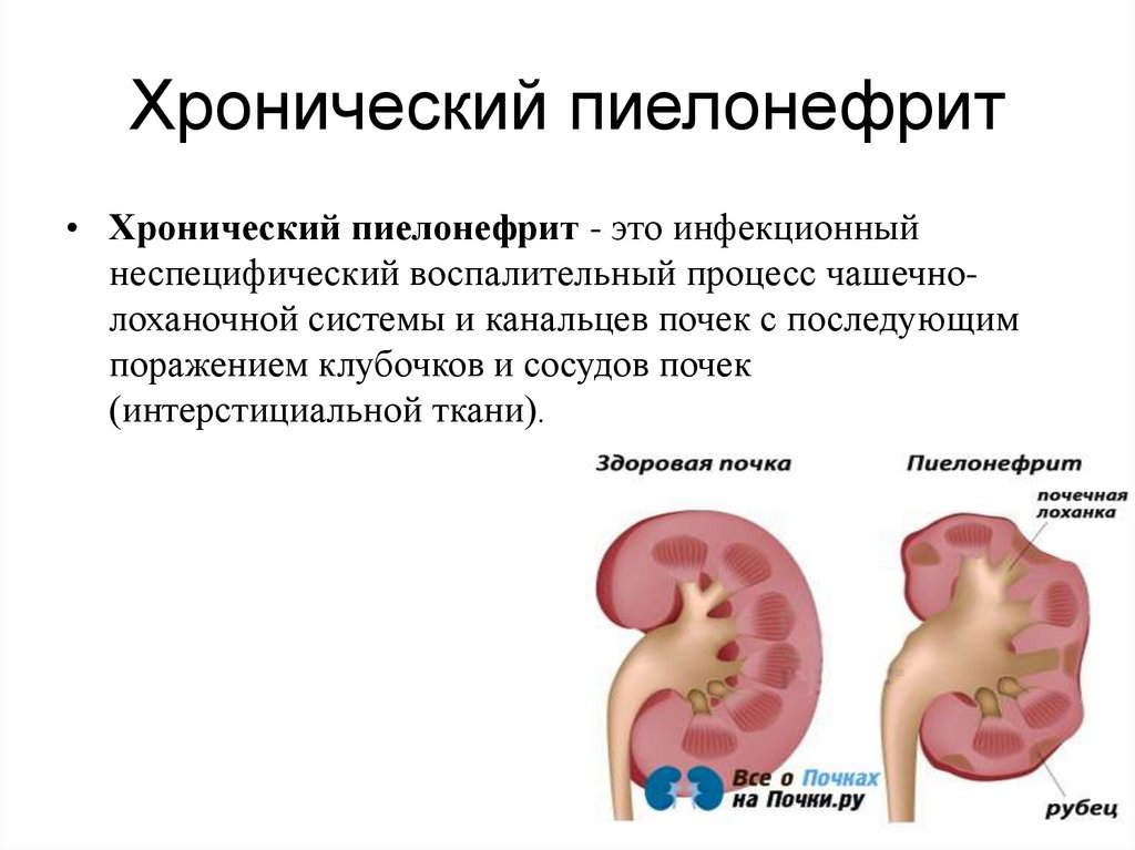 Острый пиелонефрит карта смп