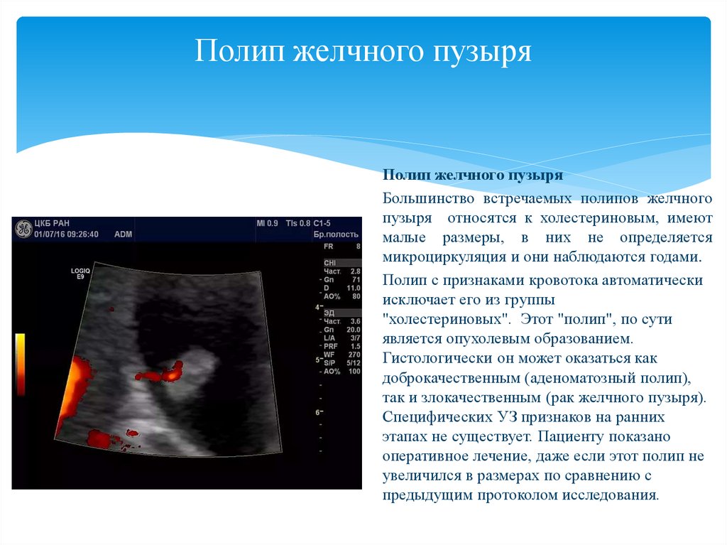 Обобщенная эхографическая картина рака желчного пузыря может быть представлена