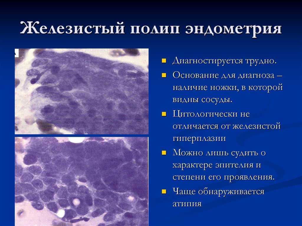 Аденоматозный полипозный синдром по утвержденным клиническим рекомендациям. Железистый полип эндометрия гистология. Фиброзно железистый полип эндометрия гистология. Гистология железисто-фиброзный полип. Железистый полип шейки матки гистология.