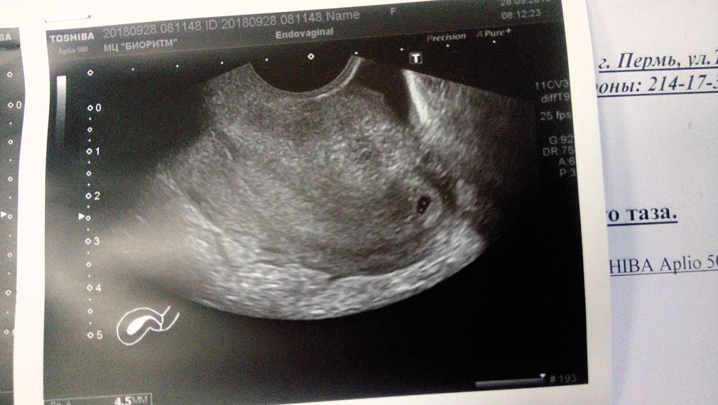 Беременность 4 недели фото эмбриона на узи