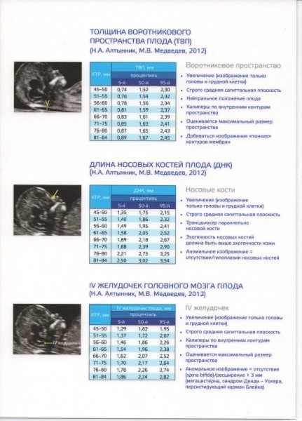 Толщина воротниковый зоны. Воротниковое пространство плода 12 недель норма. Толщина воротниковой зоны в 12 недель норма таблица. ТВП В 14 недель норма таблица.