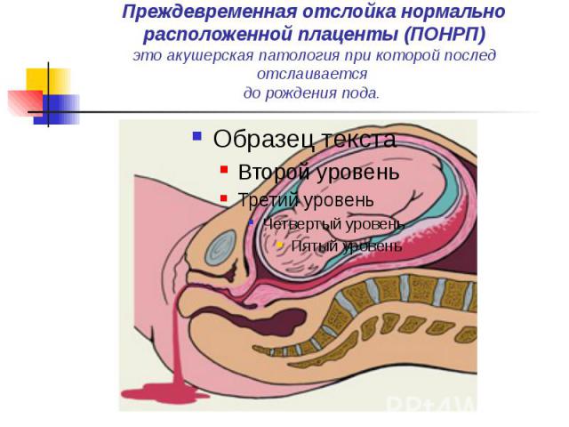 Отслойка нормально расположенной плаценты. Влагалищное исследование при ПОНРП. Заключение отслойка плаценты. Преждевременная отслойка плаценты презентация.