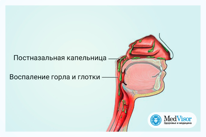 Постназальный затек лечение в домашних условиях фото 5