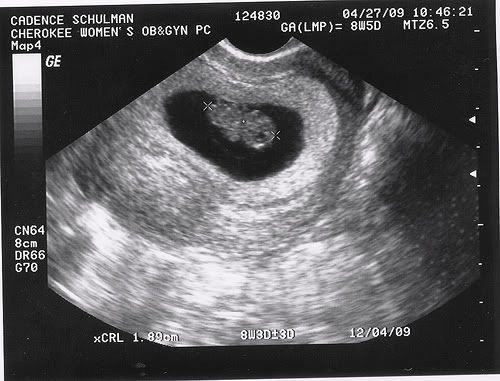 Снимок узи беременности 8 недель фото