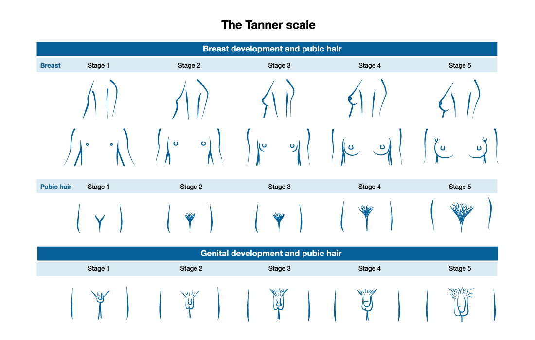 Разновидности женских органов и размеры в картинках. Лобковое оволосение по Таннеру. Степень развития молочных желез по Таннеру. Стадии развития молочных желез по Таннеру. Форма лобковых волос по возрасту.