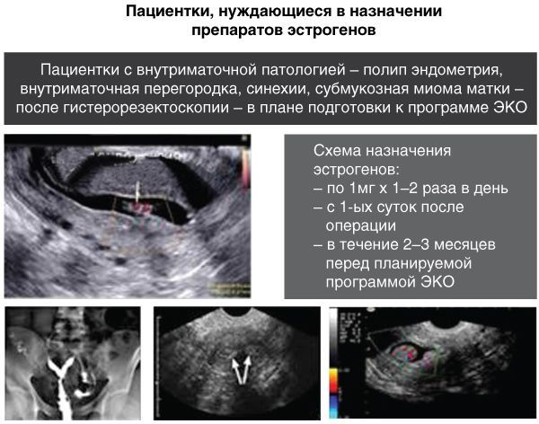 Хронический эндометрит. Схема лечения хронического эндометрита перед эко.