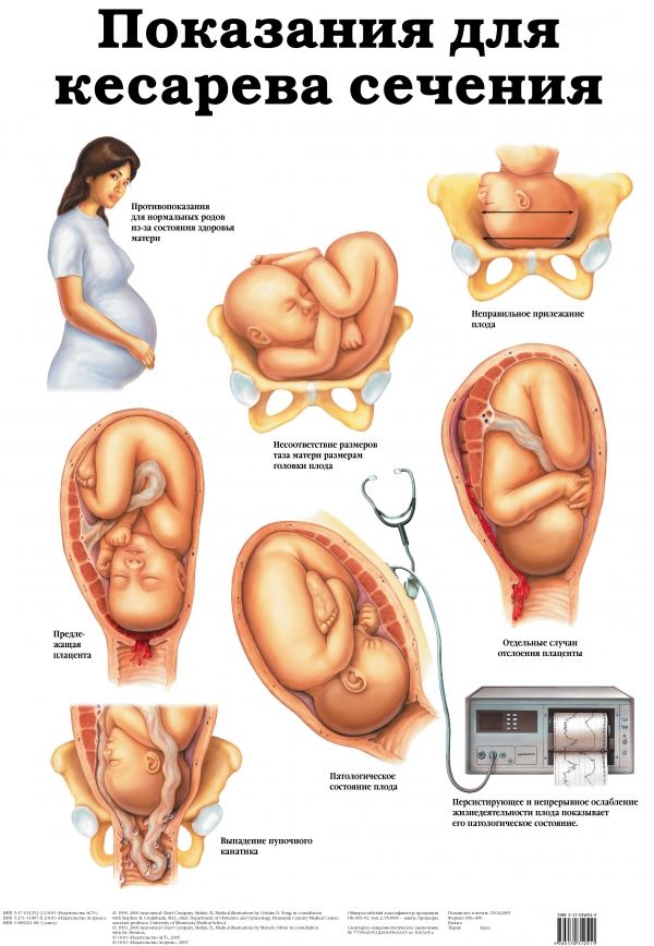 Кесарево беременности плюсы. Показания для кесарева сечения. Показания к операции кесарево сечение. Показания к кесаревому сечению.