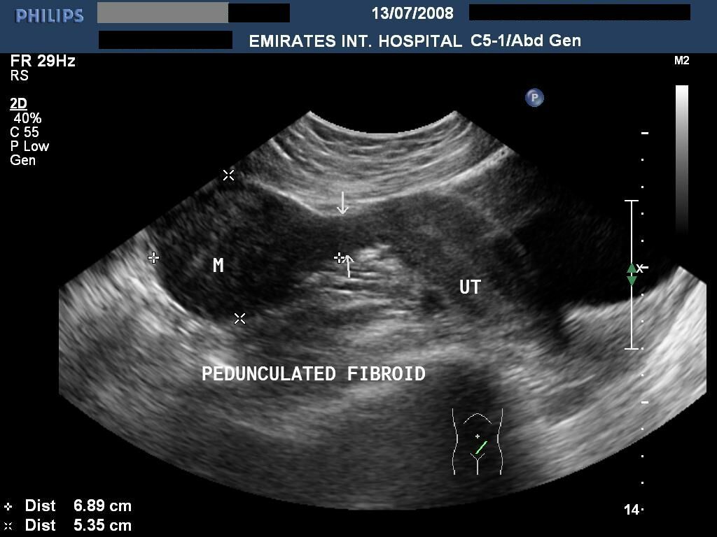 Миома матки картинки узи