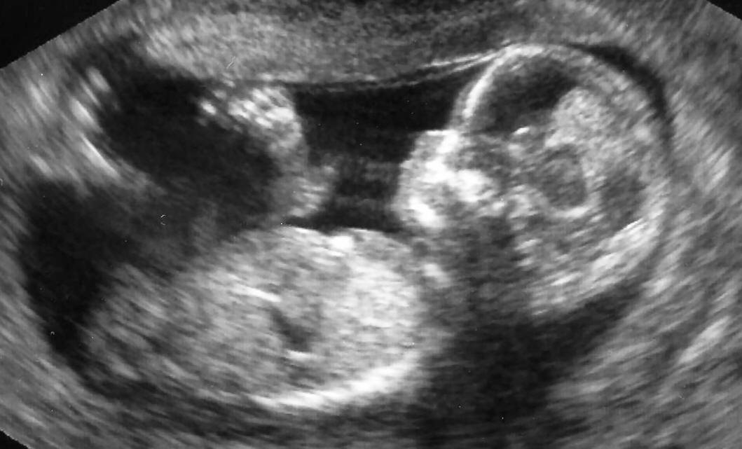 Эмбрион на 12 неделе беременности как выглядит фото
