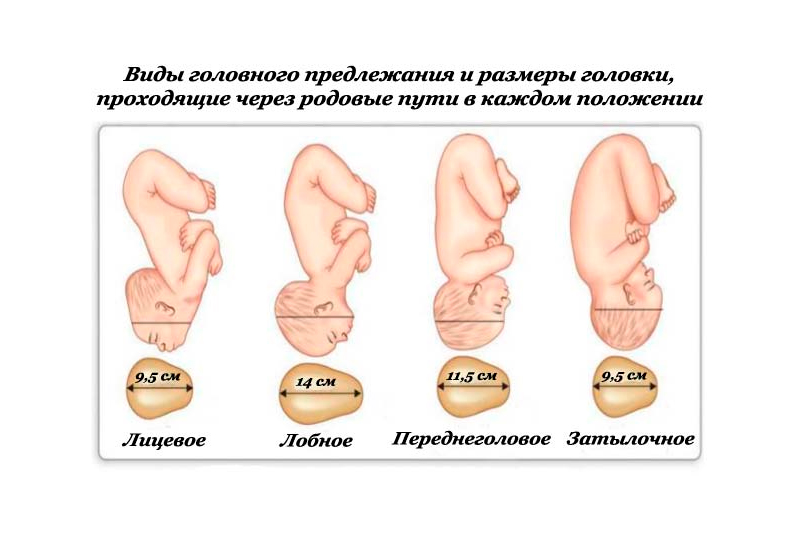 Положение плода тазовое фото