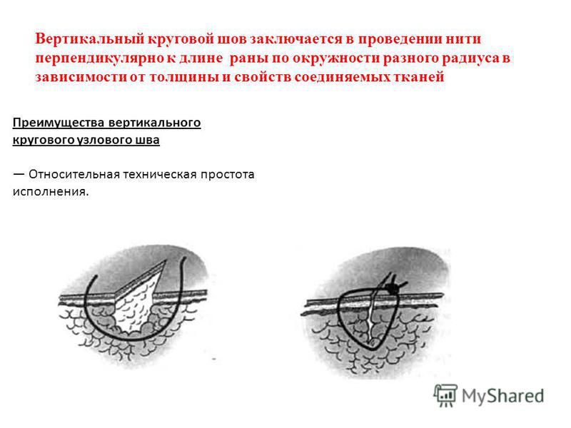 Выполнение перинеотомии эпизиотомии. Матрацный хирургический шов. Вертикальный Узловой шов в хирургии. Вертикальный круговой Узловой шов.