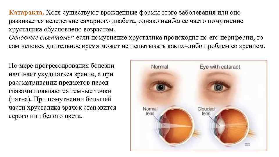 Зрения глаза болезни. Гигиена зрения предупреждение глазных болезней 8 класс. Катаракта – помутнение хрусталика глаза.. Катаракта презентация.