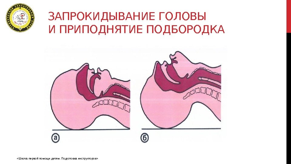 Запрокидывание головы с приподнятием подбородка