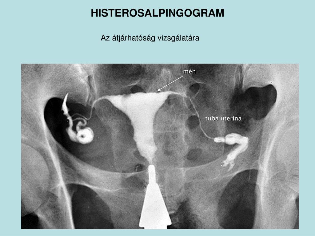 Методика гистеросальпингографии рисунок