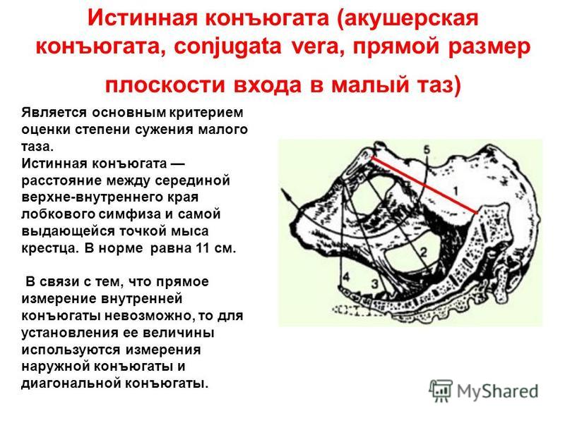 Конъюгат. Диагональная конъюгата малого таза. Истинная конъюгата.